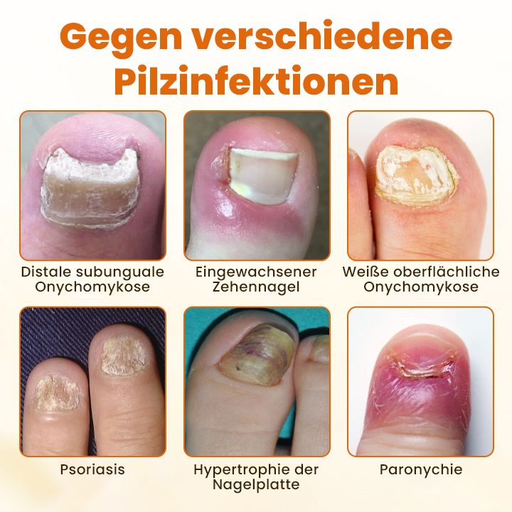 Timilk® FungiBee Fortschrittliches Nagelreparatur-Spray