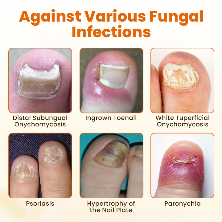 Timilk® FungiBee Fortschrittliches Nagelreparatur-Spray 🌟