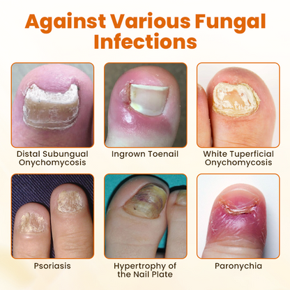Timilk® FungiBee Fortschrittliches Nagelreparatur-Spray 🌟