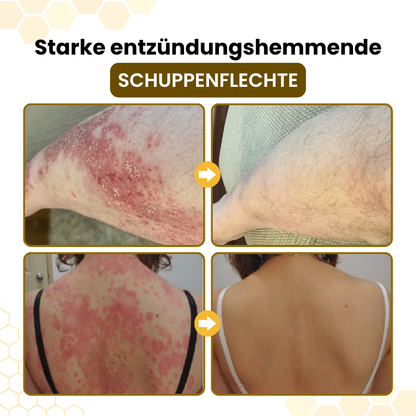 Timilk® PsoriaSoothe Fortschrittliche Bienengift Haut-Regenerationscreme